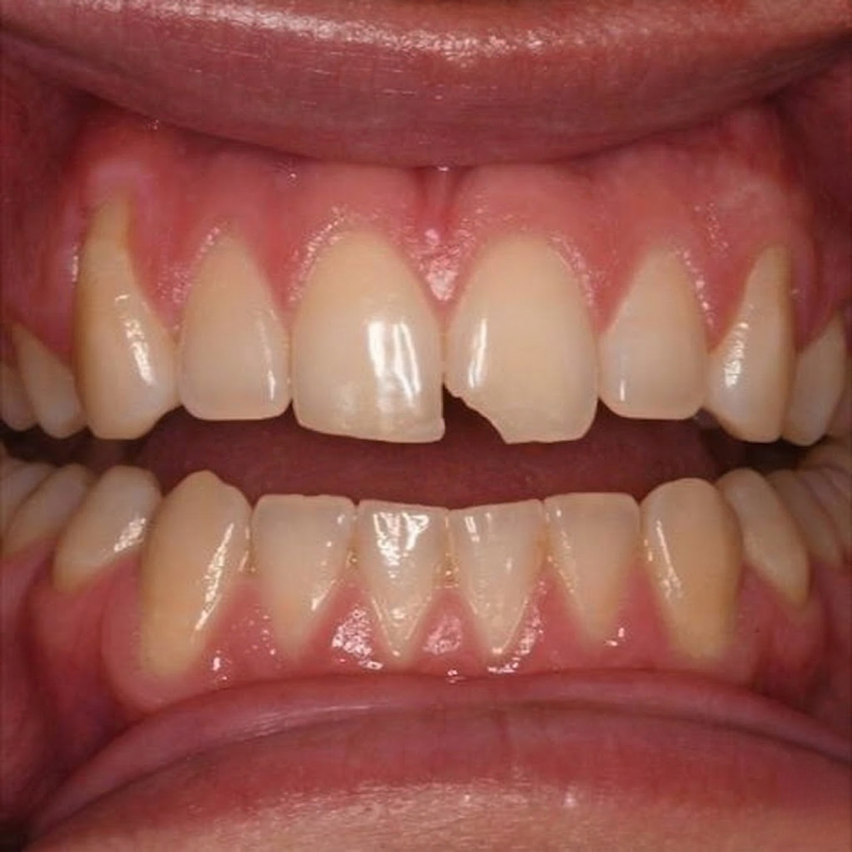 Chipped tooth treatment