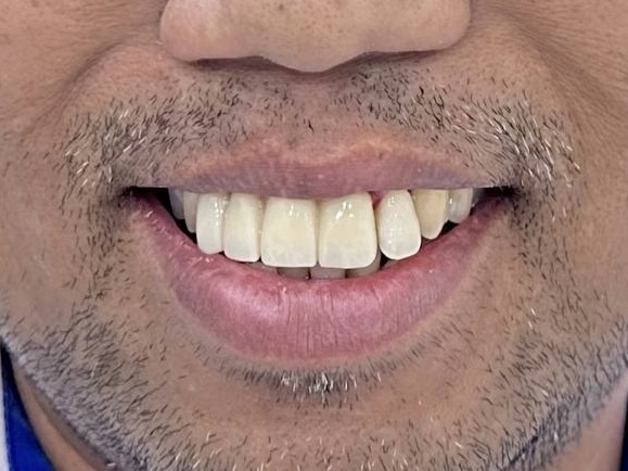 Bridge treatment