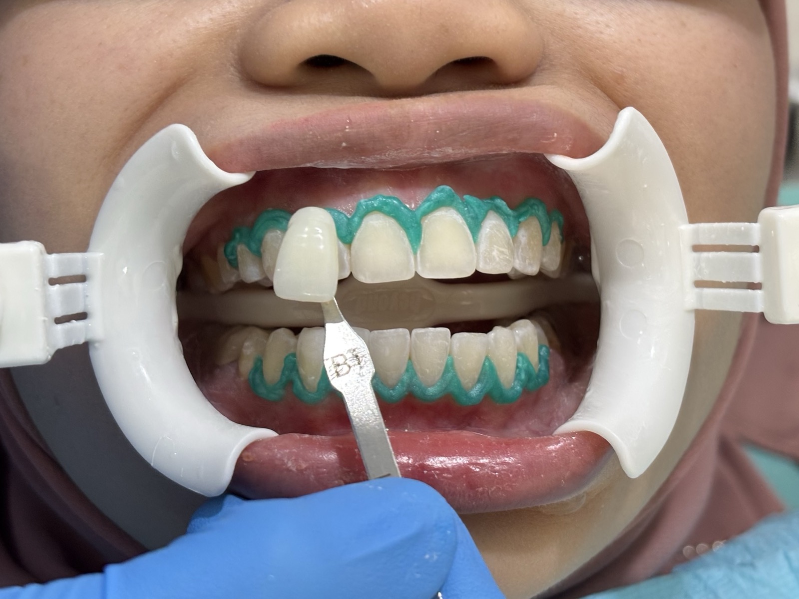 After - Whitening