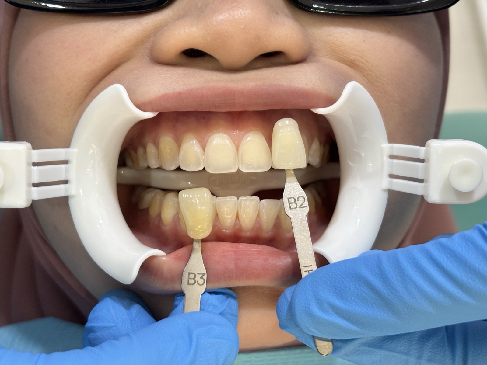 Before - Whitening