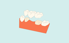 Dental bridge treatment